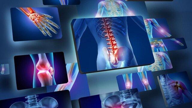 استفاده از داروی سرطان برای بیماری های التهابی استفاده از داروی سرطان برای بیماری های التهابی